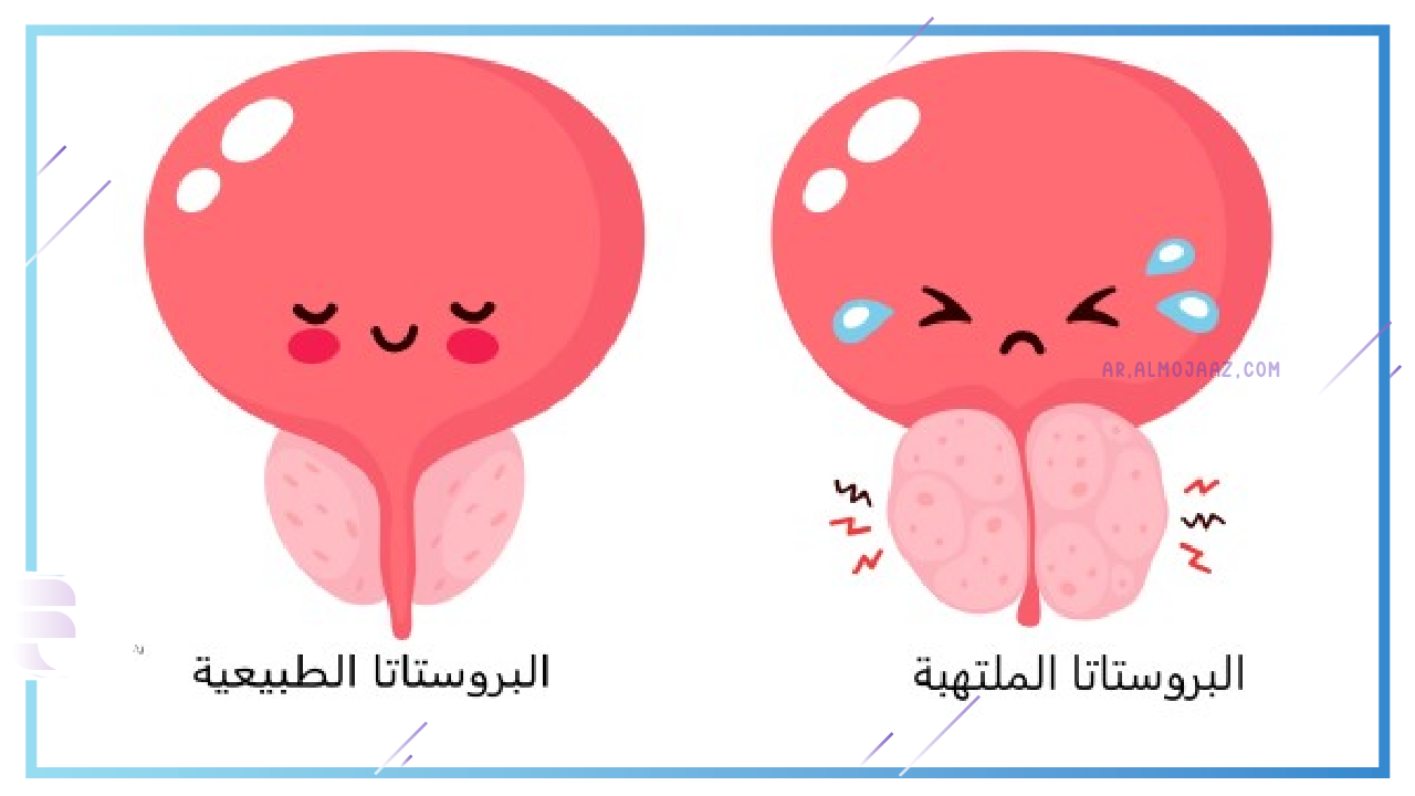 ما هي طريقة استخدام كريم البروستاتا