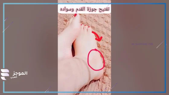 تجربتي مع سواد جوزة القدم، نصائح مفيدة لتفتيح جوزة القدمين